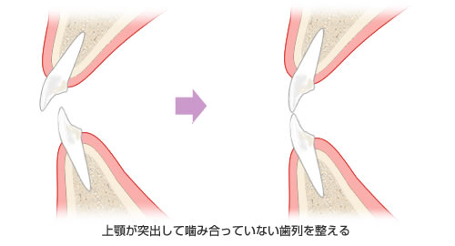 上顎歯列の矯正