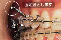 スピード矯正（インプラント矯正）のしくみ