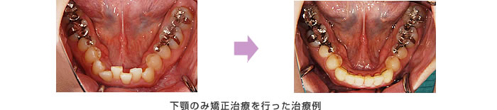 下顎の矯正治療